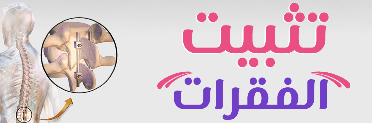 تثبيت الفقرات من الجلد